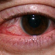 Find Natural Relief for Red, Swollen Eyes with this Chinese Herbal Remedy