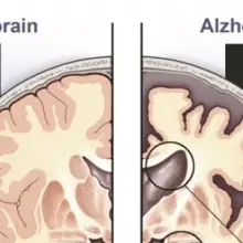 One Simple Activity Reduces Alzheimer’s and Dementia by 76 Percent, Scientists Discover