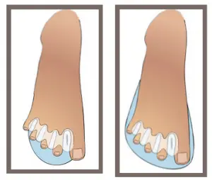 correct toes 3