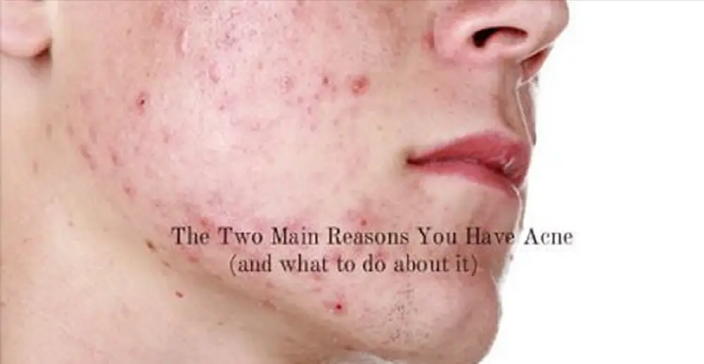The 2 Main Reasons You Have Acne (and what to do about it) | Acne, Acne