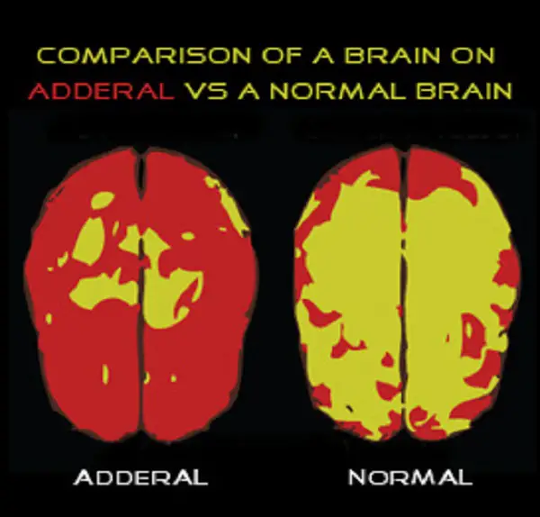 brain on adderall