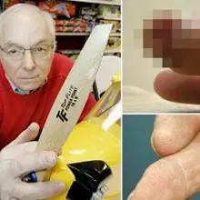 This Man Re-Grew His Finger Using “Pixie Dust” and It Is Only the Beginning