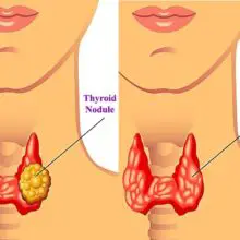 Holistic Doctor Shares: A Combination of These Three Superfoods Can Help Eliminate This Common Thyroid Problem