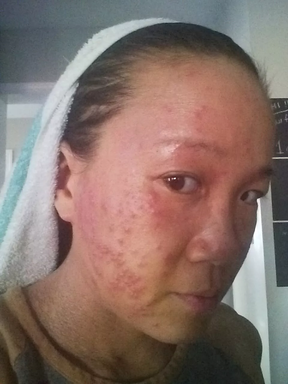Abby Tai prior to healing her eczema naturally. 
