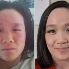 A Breakup at 15 Triggered Her Eczema: 20 Years Later, She’s Helping Others Heal Their Skin Naturally